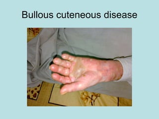 Cureus  Barrett's Esophagus in Rubinstein-Taybi Syndrome