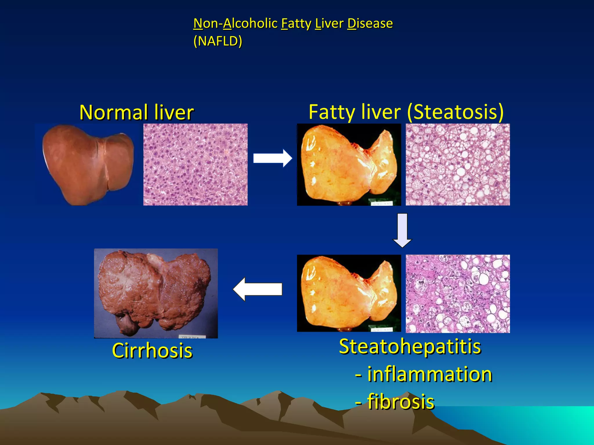 N on- A lcoholic  F atty  L iver  D isease (NAFLD)  Fatty liver (Steatosis)  Steatohepatitis - inflammation - fibrosis  Cirrhosis  Normal liver  