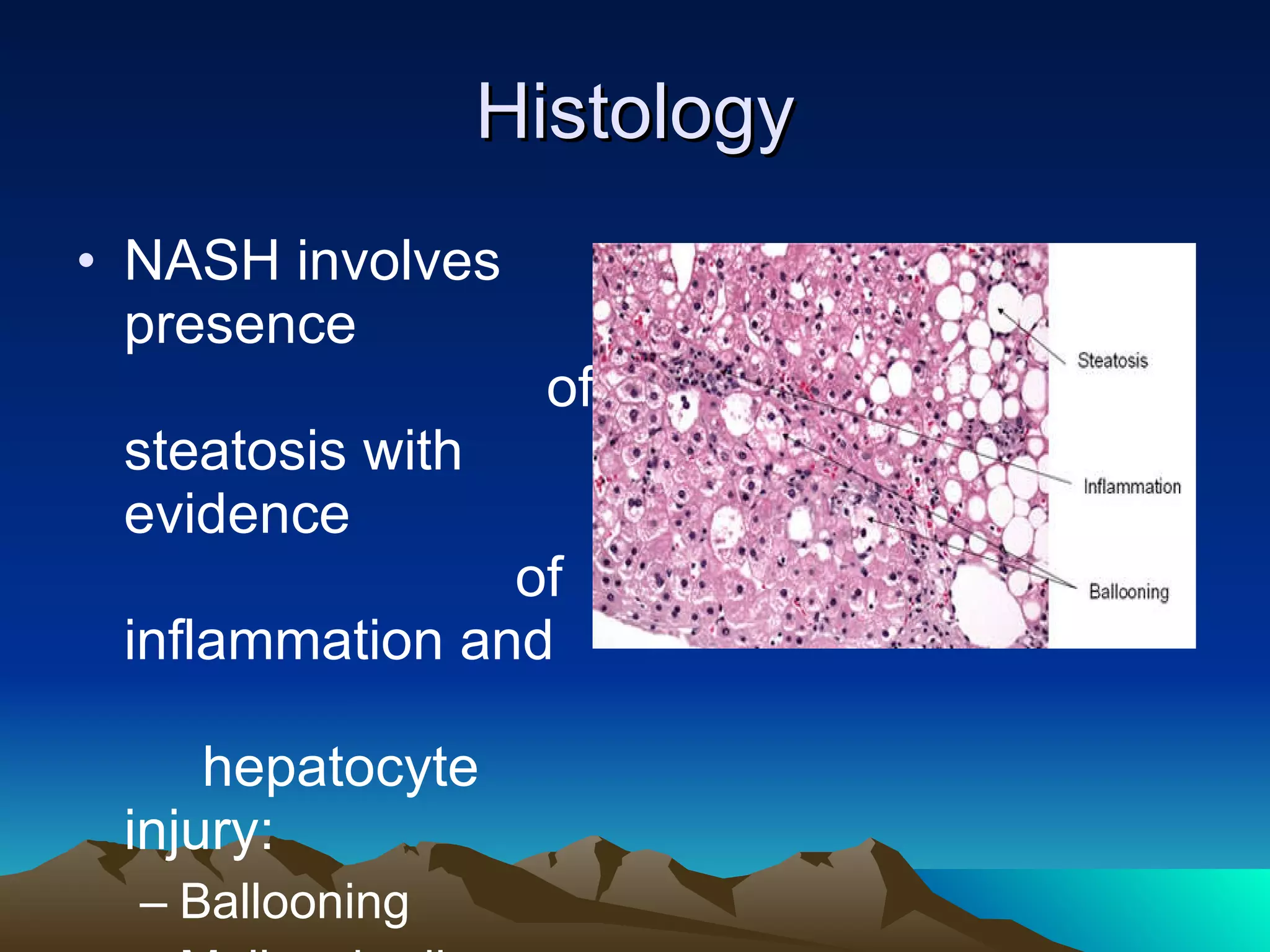 Histology NASH involves presence  of steatosis with evidence  of inflammation and  hepatocyte injury:  Ballooning  Mallory bodies 