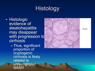 Histology Histologic evidence of steatohepatitis may disappear with progression to cirrhosis  Thus, significant proportion of cryptogenic cirrhosis is likely related to unrecognized NASH  