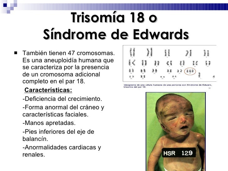 El Sindrome De Down Es Una Monosomia Y