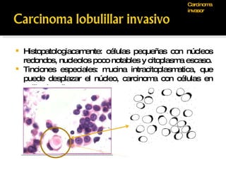 Histopatologiacamente: células pequeñas con núcleos redondos, nucleolos poco notables y citoplasma escaso. Tinciones especiales: mucina intracitoplasmatica, que puede desplazar el núcleo, carcinoma con células en anillo de sello. Carcinoma invasor 