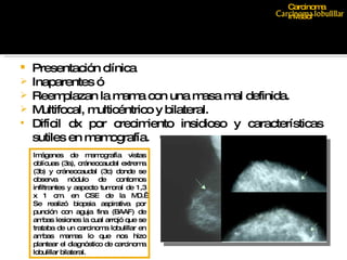 Presentación clínica Inaparentes ó Reemplazan la mama con una masa mal definida. Multifocal, multicéntrico y bilateral. Difícil dx por crecimiento insidioso y características sutiles en mamografía. Imágenes de mamografía vistas oblícuas (3a), cráneocaudal extrema (3b) y cráneocaudal (3c) donde se observa nódulo de contornos infiltrantes y aspecto tumoral de 1,3 x 1 cm. en CSE de la MD.  Se realizó biopsia aspirativa por punción con aguja fina (BAAF) de ambas lesiones la cual arrojó que se trataba de un carcinoma lobulillar en ambas mamas lo que nos hizo plantear el diagnóstico de carcinoma lobulillar bilateral. Carcinoma invasor 