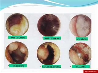 FORUNCOLO    OTITE VIRALE   CANDIDA




 ESOSTOSI   COLESTEATOMA    ECZEMA

                                 www.otoiatria.it
 
