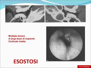 Multiple lesioni
A larga base di impianto
Corticale intatta




    ESOSTOSI
                           www.otoiatria.it
 