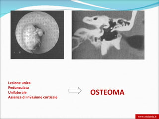 Lesione unica
Pedunculata
Unilaterale
Assenza di invasione corticale
                                 OSTEOMA

                                           www.otoiatria.it
 