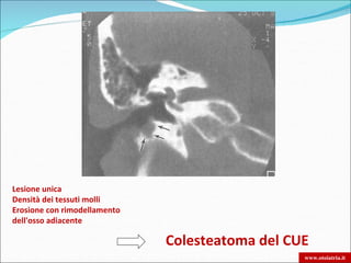 Lesione unica
Densità dei tessuti molli
Erosione con rimodellamento
dell'osso adiacente

                              Colesteatoma del CUE
                                                 www.otoiatria.it
 