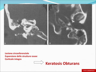 Lesione circonferenziale
Espansione delle strutture ossee
Corticale integra

                                   Keratosis Obturans
                                                        www.otoiatria.it
 