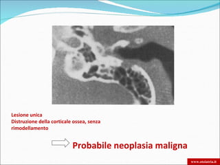 Lesione unica
Distruzione della corticale ossea, senza
rimodellamento


                           Probabile neoplasia maligna
                                                         www.otoiatria.it
 