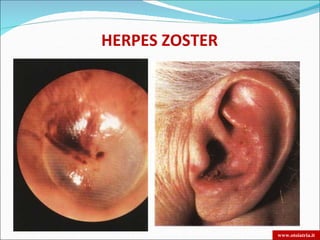 HERPES ZOSTER




                www.otoiatria.it
 