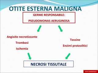 OTITE ESTERNA MALIGNA
                   GERME RESPONSABILE:
                 PSEUDOMONAS AERUGINOSA



Angioite necrotizzante
                                          Tossine
      Trombosi
                                    Enzimi proteolitici
      Ischemia



                  NECROSI TISSUTALE
                                                     www.otoiatria.it
 