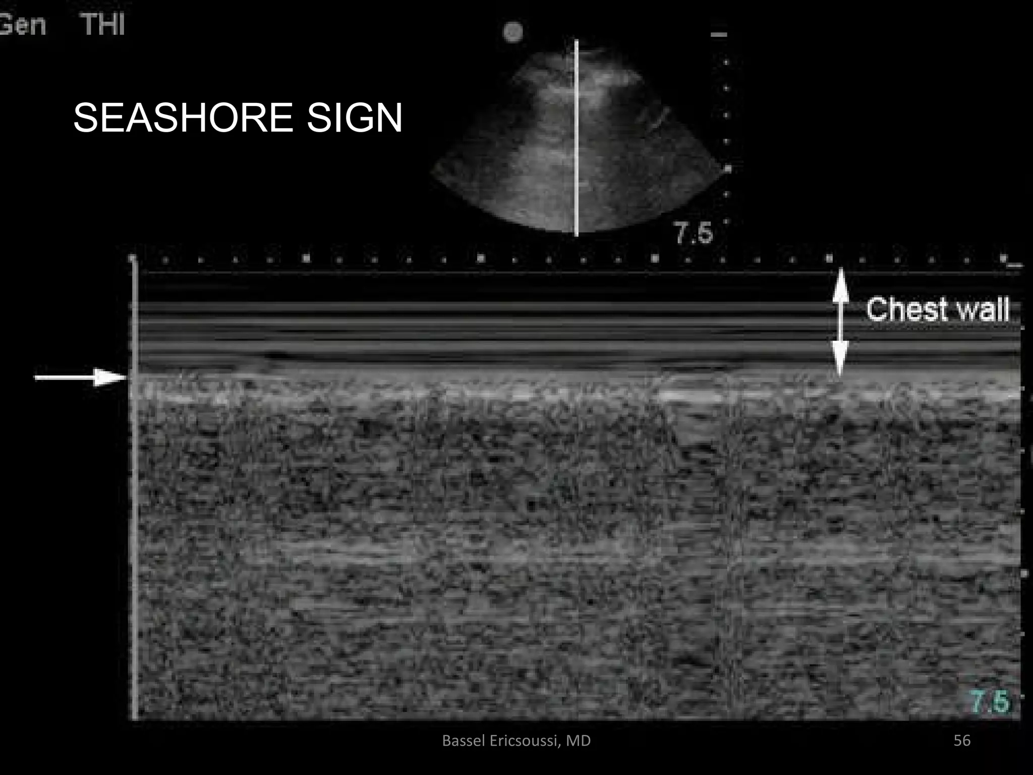 Ultrasonography Fundamentals In Critical Care: Lung Ultrasound, Pleural ...