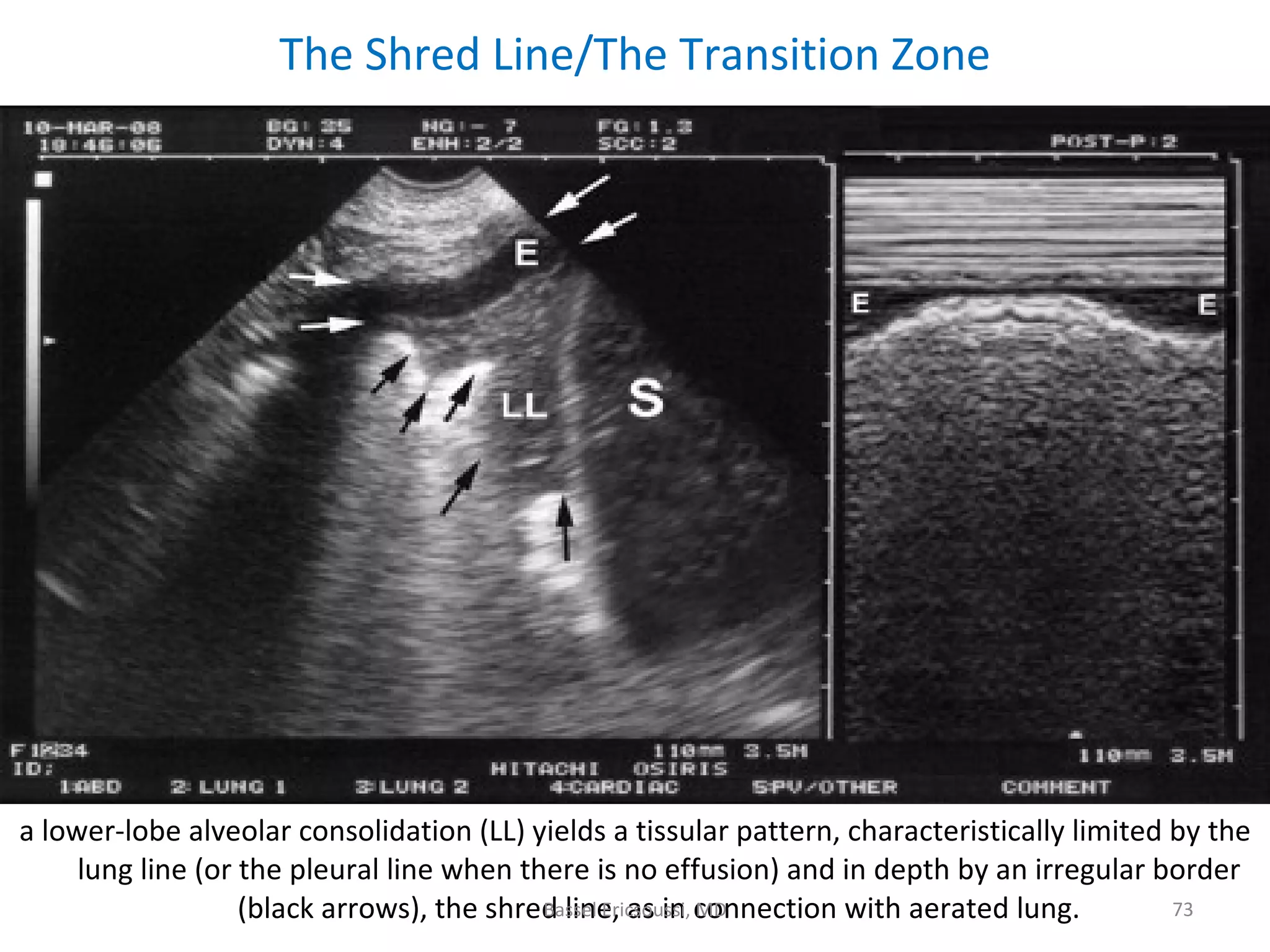 Ultrasonography Fundamentals In Critical Care: Lung Ultrasound, Pleural ...