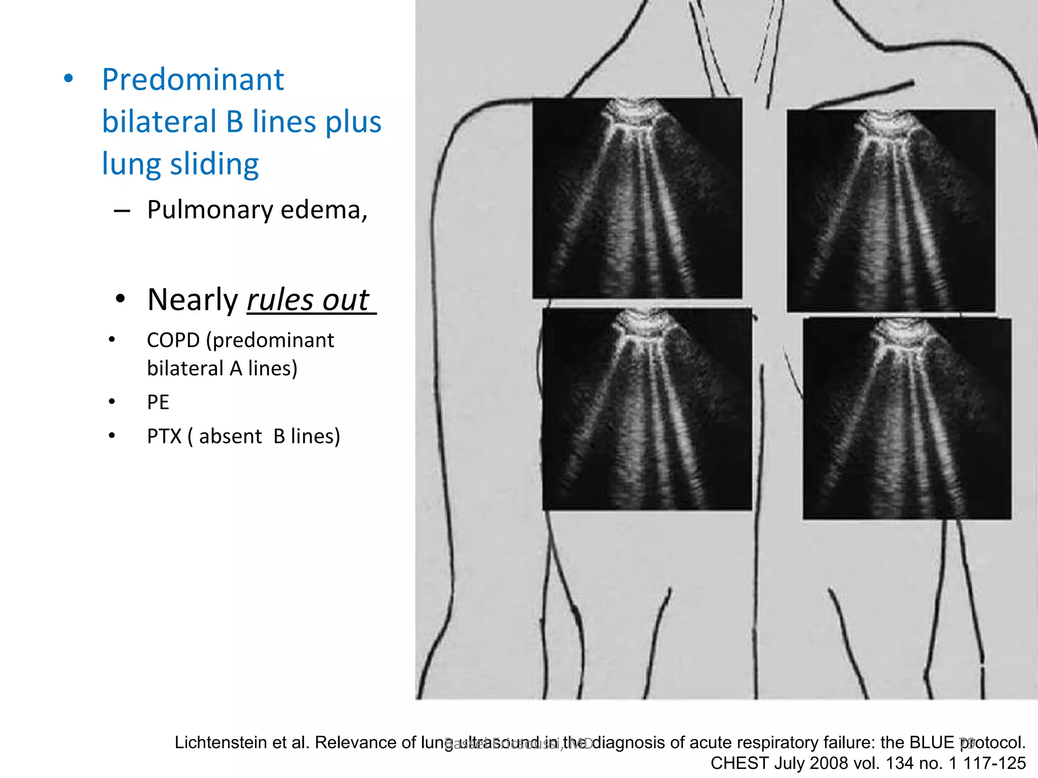 Ultrasonography Fundamentals In Critical Care: Lung Ultrasound, Pleural ...