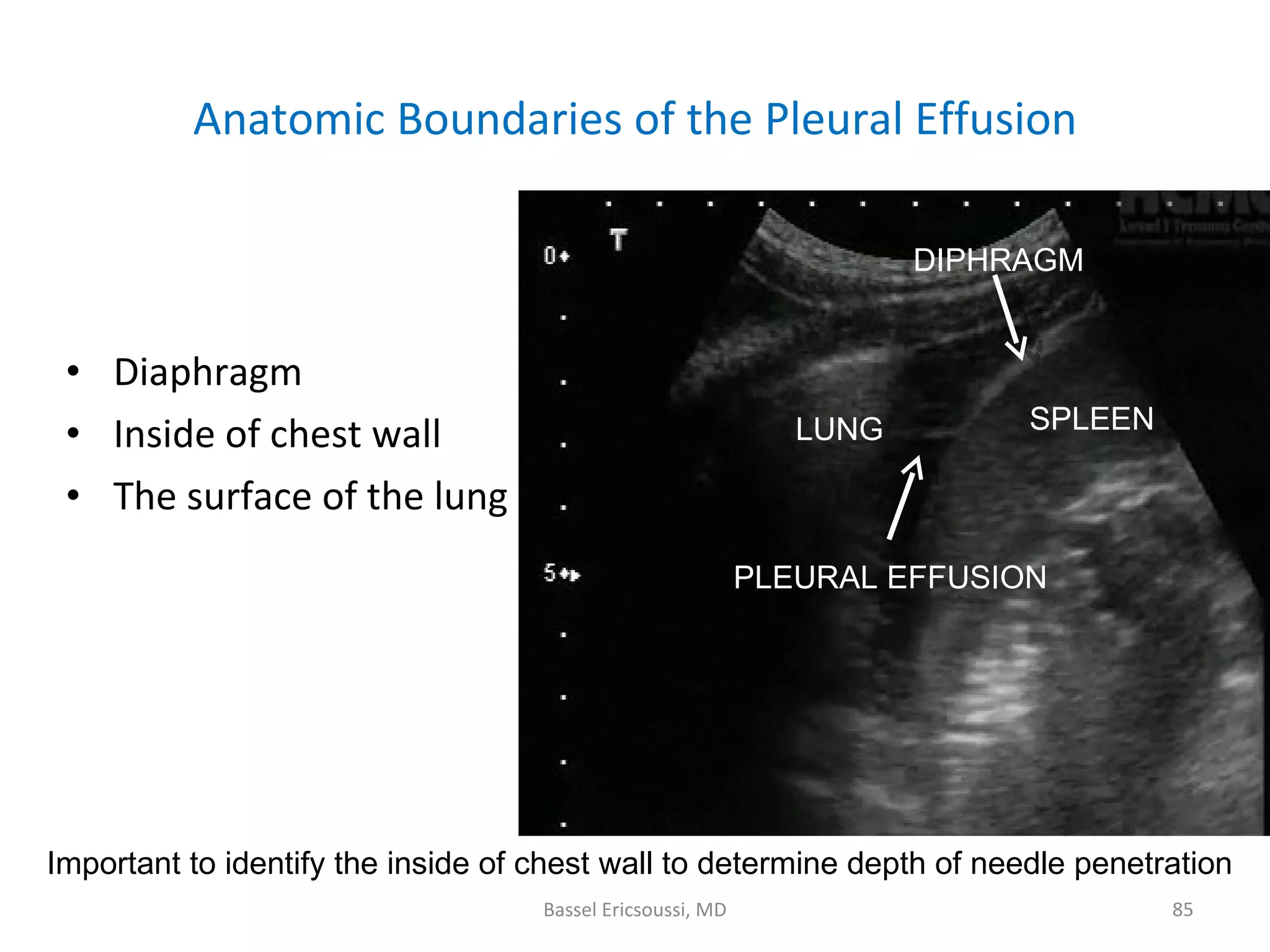 Ultrasonography Fundamentals In Critical Care: Lung Ultrasound, Pleural ...