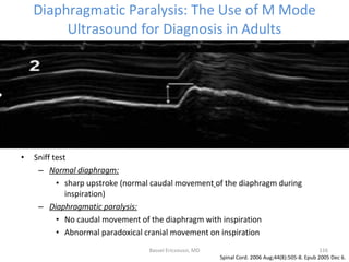 Diaphragmatic Paralysis: The Use of M Mode Ultrasound for Diagnosis in Adults <ul><li>Sniff test </li></ul><ul><ul><li>Nor...