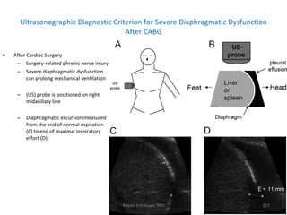 Ultrasonographic Diagnostic Criterion for Severe Diaphragmatic Dysfunction After CABG <ul><li>After Cardiac Surgery  </li>...