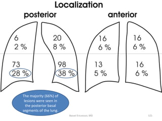 The majority (66%) of lesions were seen in the posterior basal segments of the lung. Bassel Ericsoussi, MD 