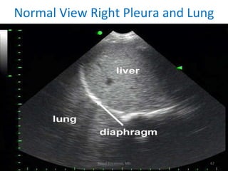 Normal View Right Pleura and Lung Bassel Ericsoussi, MD 