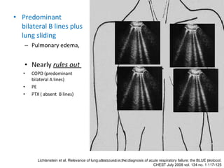 <ul><li>Predominant bilateral B lines plus lung sliding </li></ul><ul><ul><li>Pulmonary edema, </li></ul></ul><ul><ul><li>...