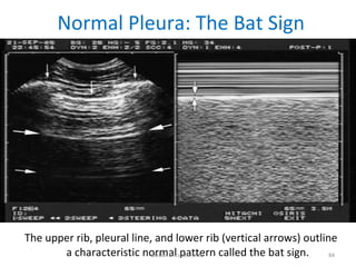 Normal Pleura: The Bat Sign <ul><li>The upper rib, pleural line, and lower rib (vertical arrows) outline a characteristic ...