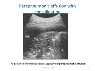 Parapneumonic effusion with consolidation <ul><li>The presence of consolidation is suggestive of parapneumonic effusion </...