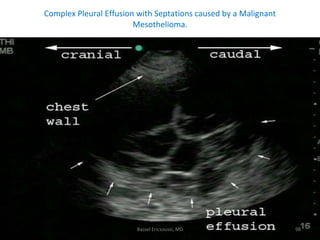 Complex Pleural Effusion with Septations caused by a Malignant Mesothelioma. Bassel Ericsoussi, MD 