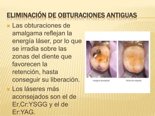 Eliminación de obturaciones antiguas Las obturaciones de amalgama reflejan la energía láser, por lo que se irradia sobre las zonas del diente que favorecen la retención, hasta conseguir su liberación. Los láseres más aconsejados son el de Er,Cr:YSGG y el de Er:YAG.