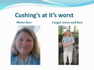 Cushing’s at it’s worst
Moon face     Larger torso and face
 