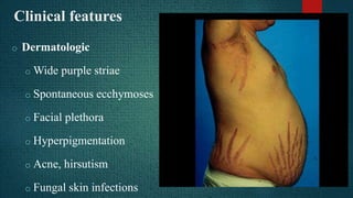 Cushing Rash Cushing's syndrome | PPTX