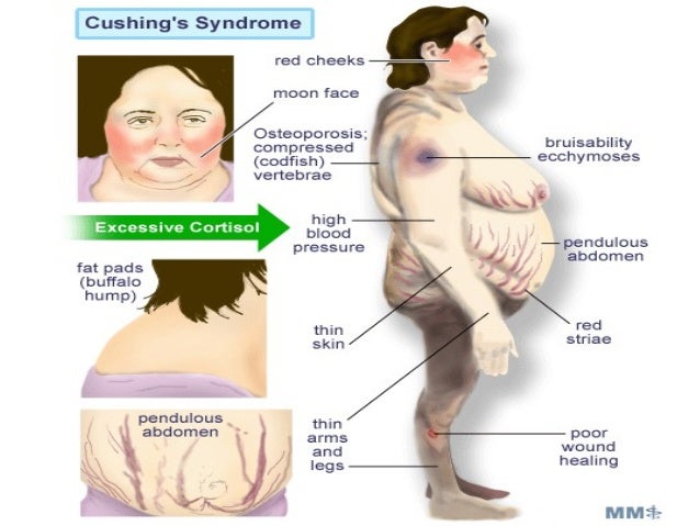 cushing s cushing s 1 cushing s cushing s 1