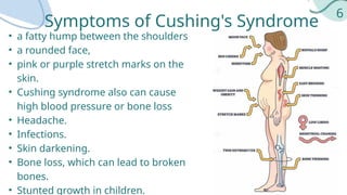 Cushingoid Rash Comprehensive Overview of Cushing's Syndrome: Causes, Symptoms, and ...