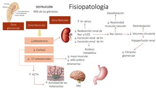 ↓Aldosterona
↓ Cortisol
↓ 17-cetosteroides
↓ Reabsorción renal de
Na+ y H2O
↓ Excreción renal de K+
↓ Excreción renal de H+
↓ Na+ sérico ↓ Volumen circulante
Hipoperfusión renal
↓ Filtración
glomerular
Deshidratación
↓ Reactividad
muscular vascular
Vasodilatación
Acidosis
metabólica
↑ K+ sérico
↑ ACTH
↑ Actividad de los
melanocitos
↓ masa muscular
↓ vello púbico
Amenorrea
DESTRUCCIÓN
90% de las glándulas
Zona
glomerular
Zona fascicular
Zona Reticular
Zona
glomerular
Zona fascicular
Zona Reticular
SNC
Fisiopatología
 
