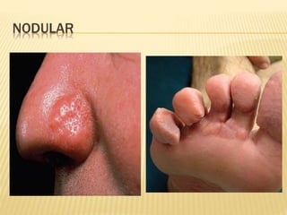 NODULAR
 