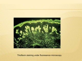 Thioflavin staining under fluoresence microscopy
 