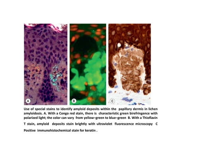 Cutaneous amyloidosis by dermatology resident.pptx | Blood Disorders ...