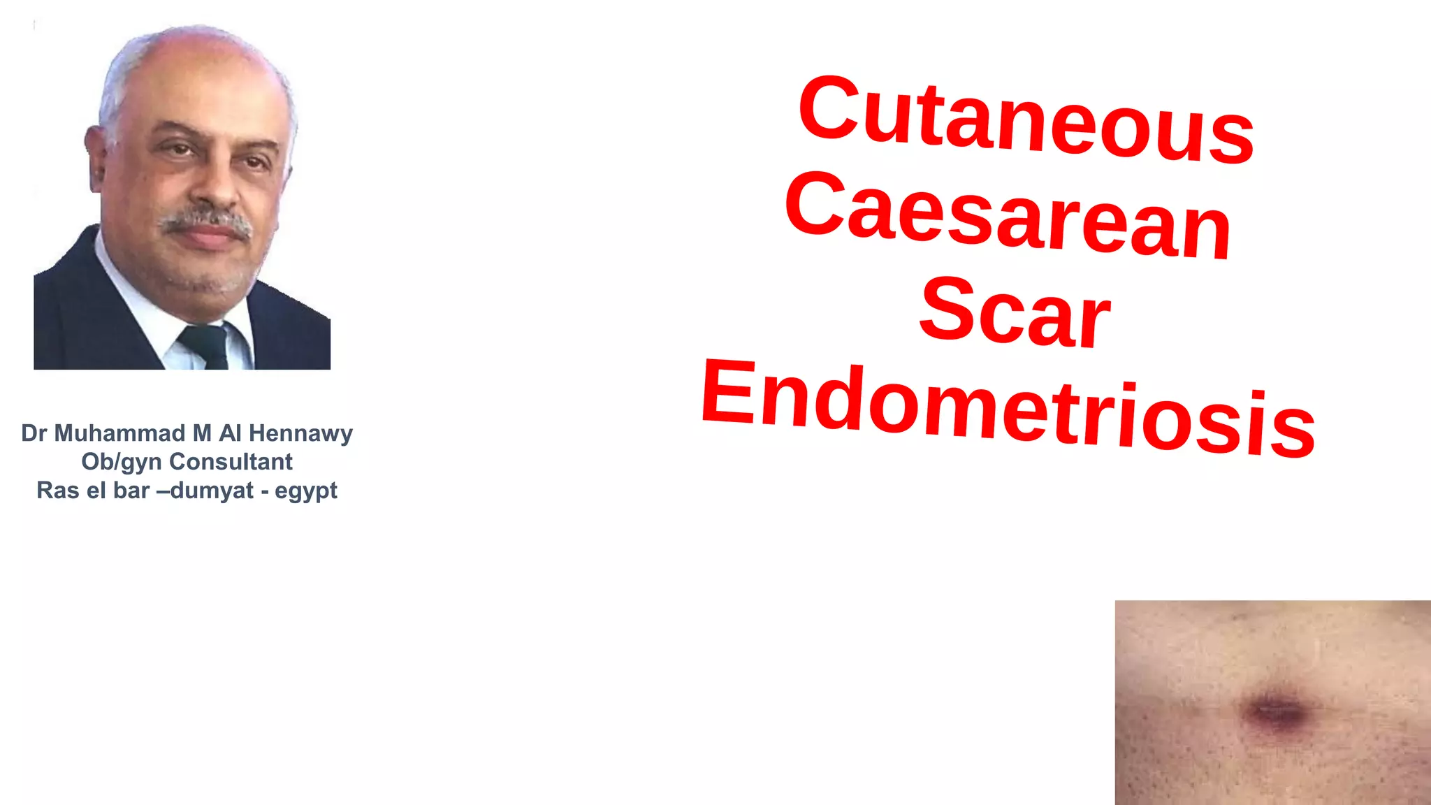 Cutaneous cesarean scar endometriosis PPT