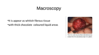 Macroscopy
•It is appear as whitish fibrous tissue
•with thick chocolate coloured liquid areas
 