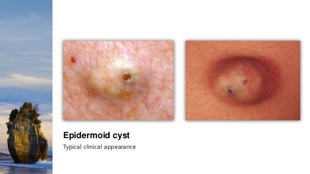 Cutaneous Cysts diagram of epidermal inclusion cyst 