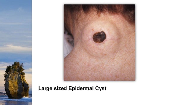 cutaneous cysts how long does it take for a cyst to form