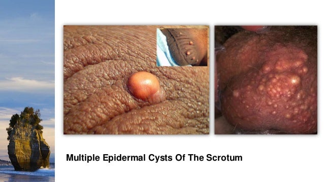 Cutaneous Cysts
