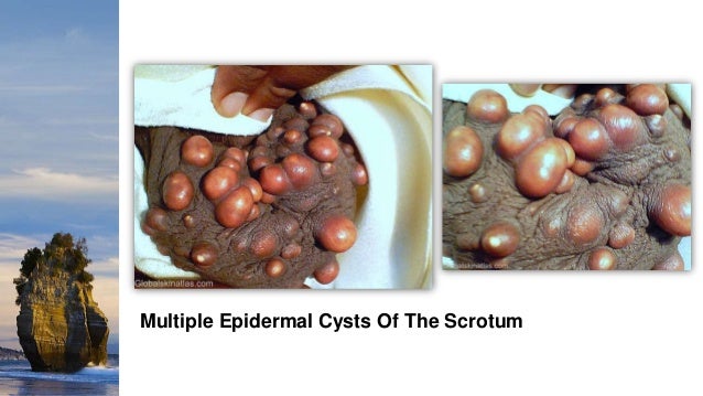 Cutaneous Cysts