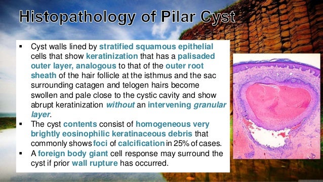 Cutaneous Cysts