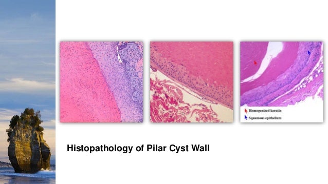 Cutaneous Cysts