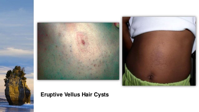 Cutaneous Cysts