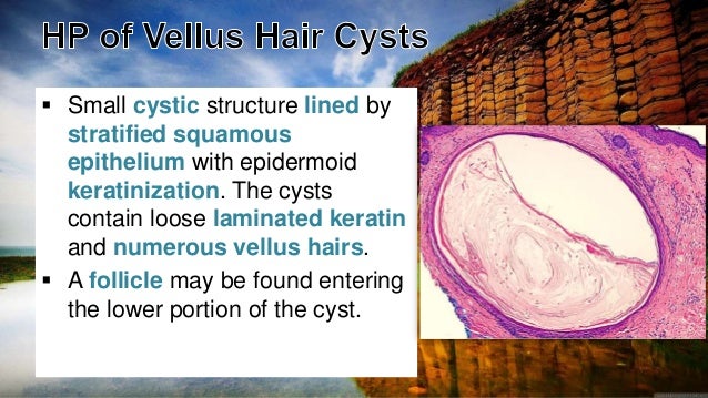 Cutaneous Cysts