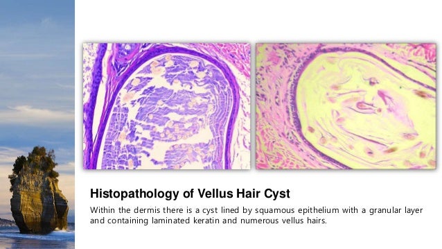 Cutaneous Cysts