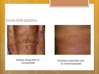 Cutaneous Drug eruptions (part-2).pptxcc | PPT
