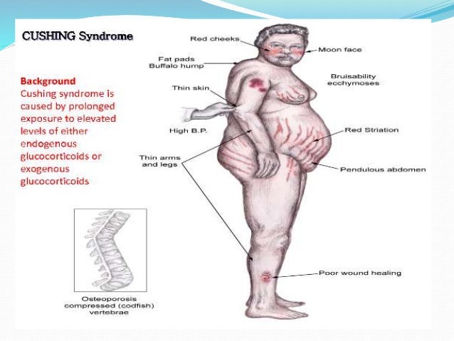 Cutaneous features of endocrine diseases Cutaneous features of endocrine diseases