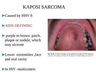 KAPOSI SARCOMA
▶Caused by HHV 8
▶AIDS DEFINING
▶ purple to brown patch,
plaque or nodule, which
may ulcerate
▶Lower extremities ,face
and oral cavity
▶In HIV -multicentric
 